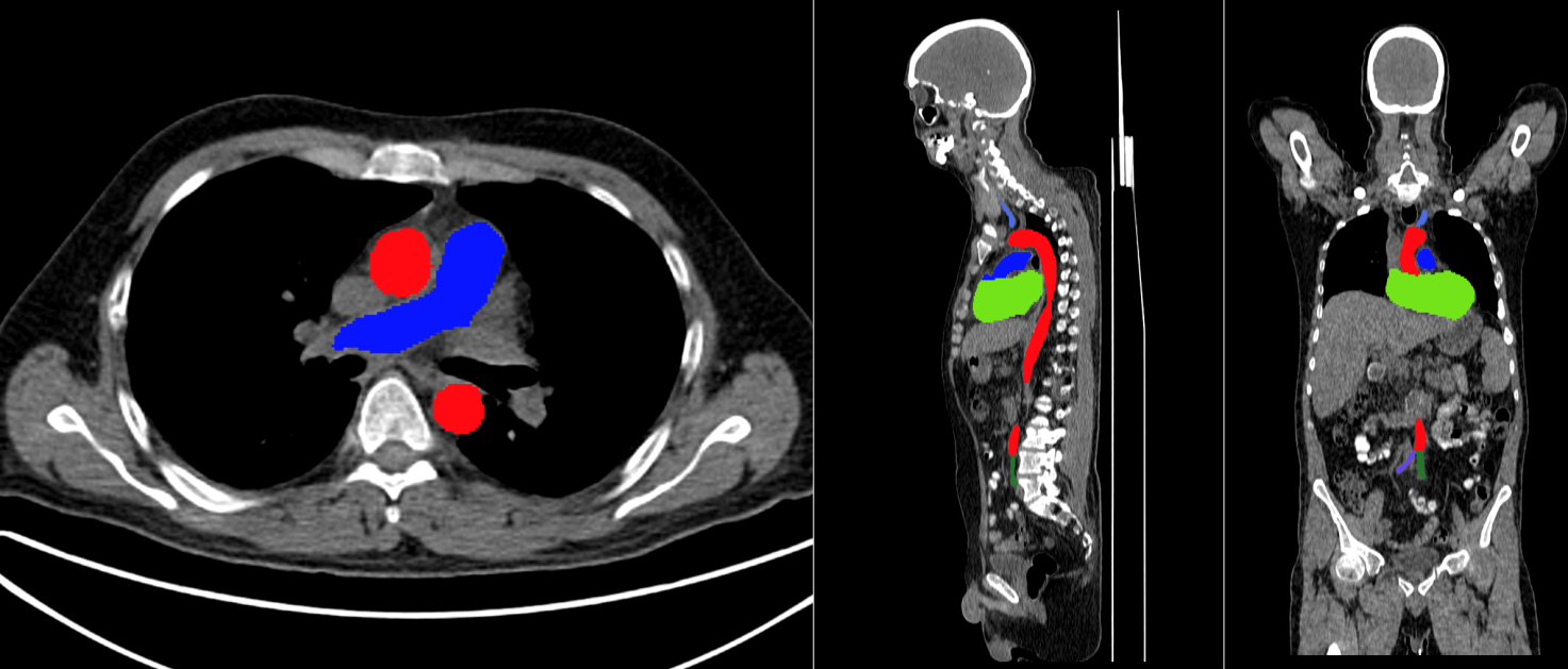 Fulltext | Atherosclerosis Assessment by Total-Body PET/CT